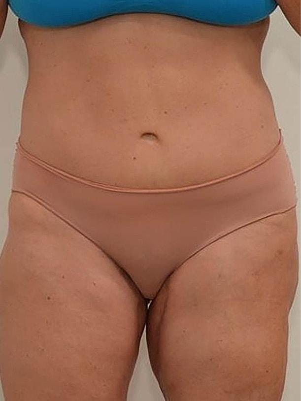 Pacific Plastic Surgery Group (Edward P. Miranda, MD) tummy tuck after — San Francisco, CA