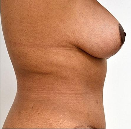 Breast Lift after at Pacific Plastic Surgery Group (Edward P. Miranda, MD) in San Francisco, CA