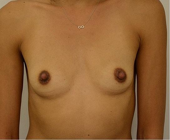 Breast Augmentation before at Pacific Plastic Surgery Group (Edward P. Miranda, MD) in San Francisco, CA