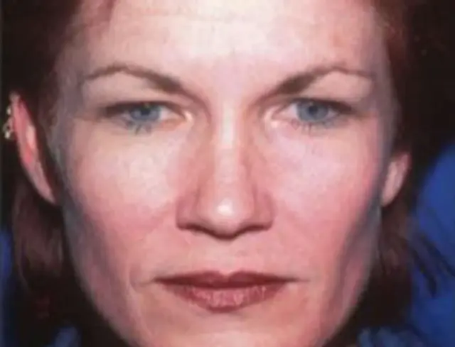 Brow Lift before at Berman Plastic Surgery & Spa in Boca Raton, FL