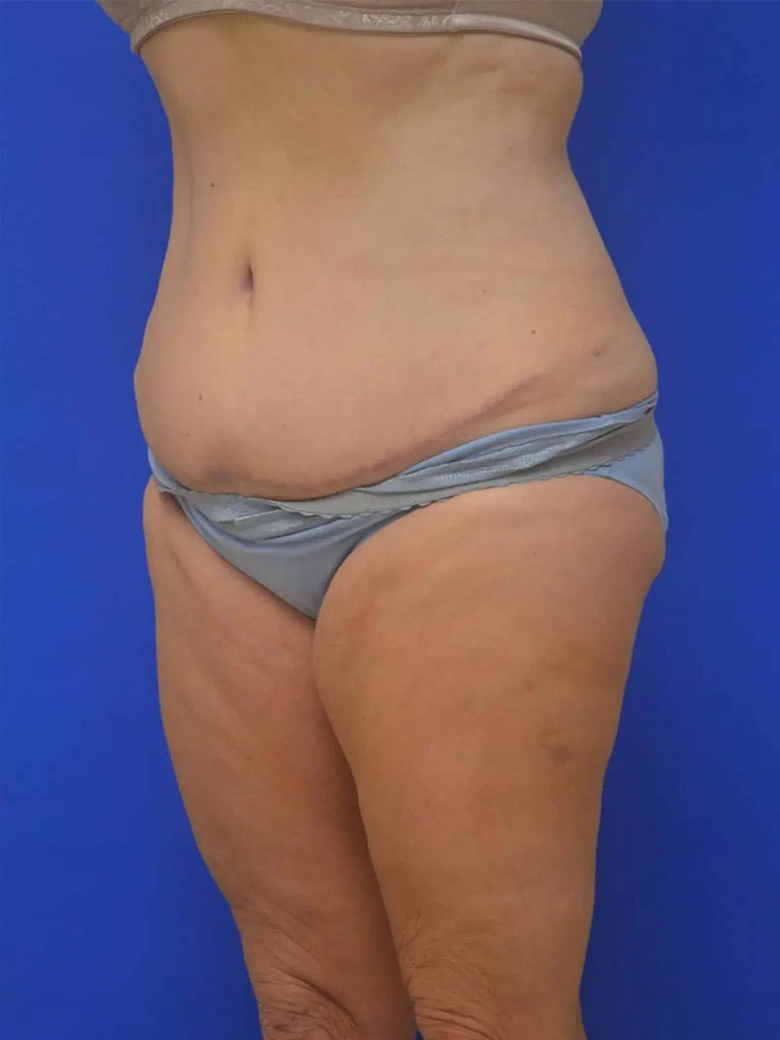 Berman Plastic Surgery & Spa tummy tuck after — Boca Raton, FL