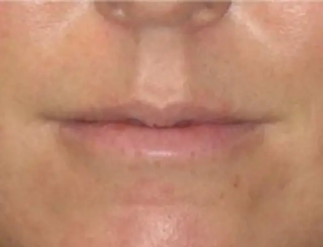 Lip Filler before at Berman Plastic Surgery & Spa in Boca Raton, FL