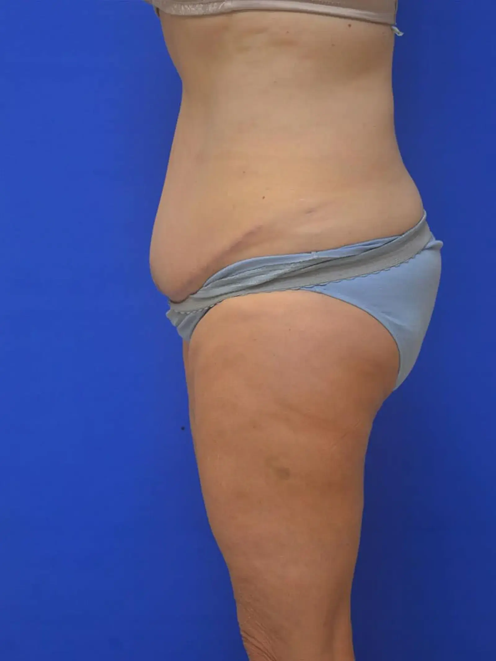 Berman Plastic Surgery & Spa tummy tuck after — Boca Raton, FL