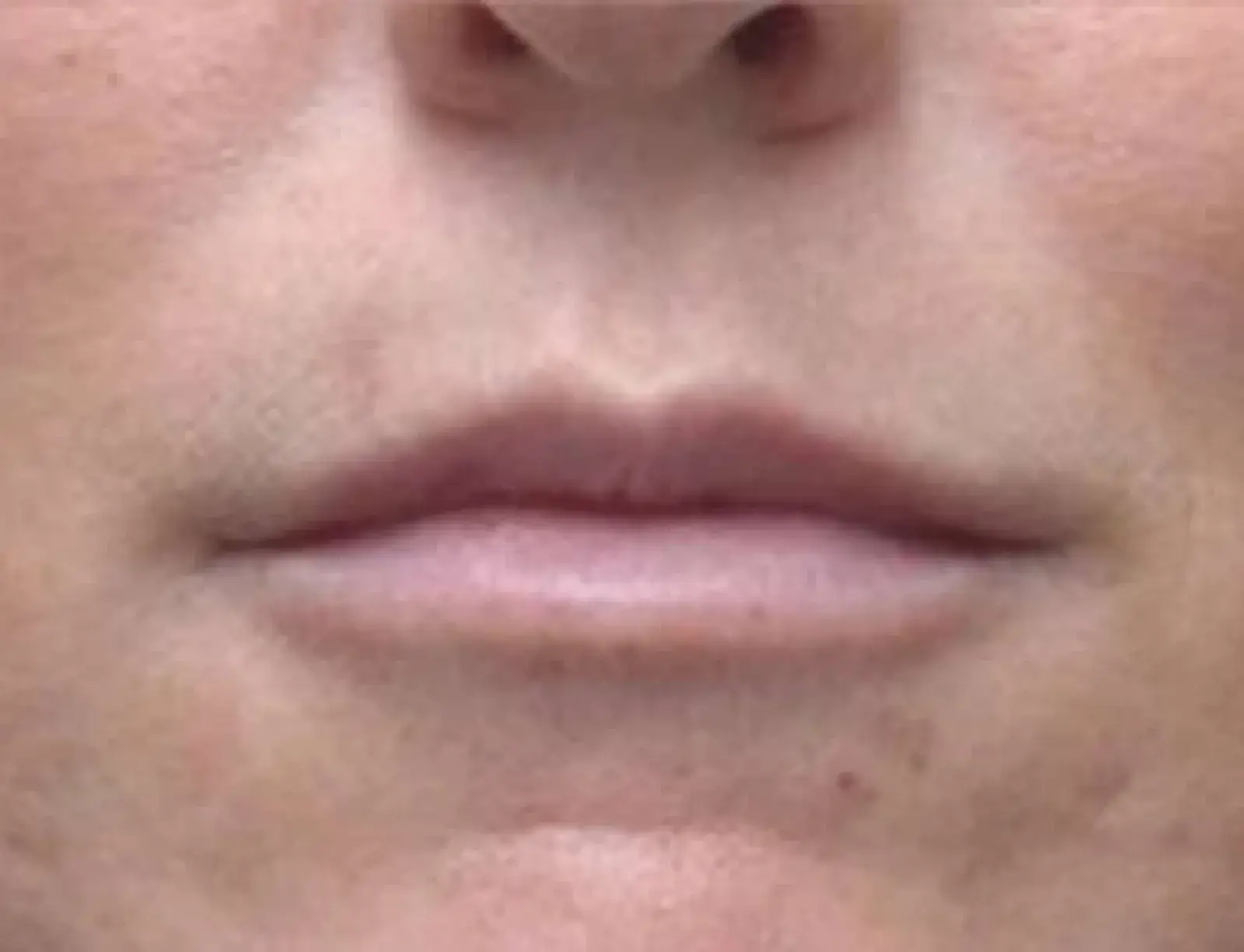 Berman Plastic Surgery & Spa lip filler after — Boca Raton, FL