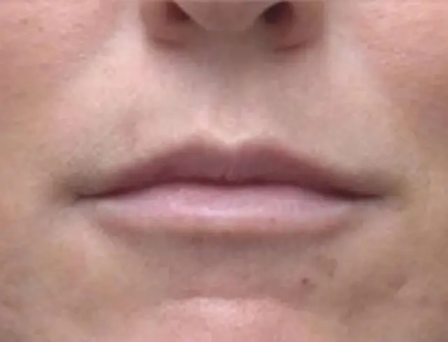 Lip Filler after at Berman Plastic Surgery & Spa in Boca Raton, FL