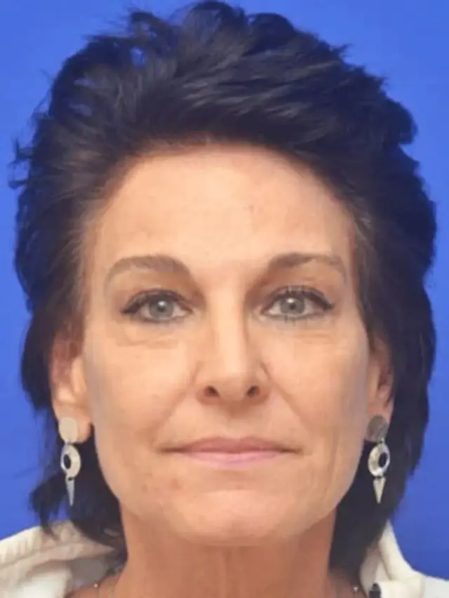 Laser Skin Resurfacing after at Berman Plastic Surgery & Spa in Boca Raton, FL