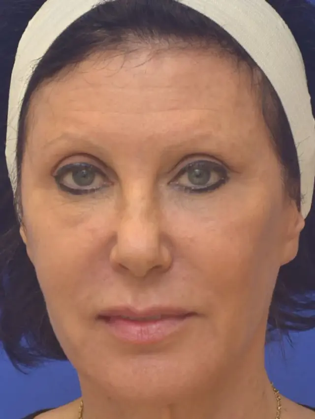 Chemical Peel after at Berman Plastic Surgery & Spa in Boca Raton, FL