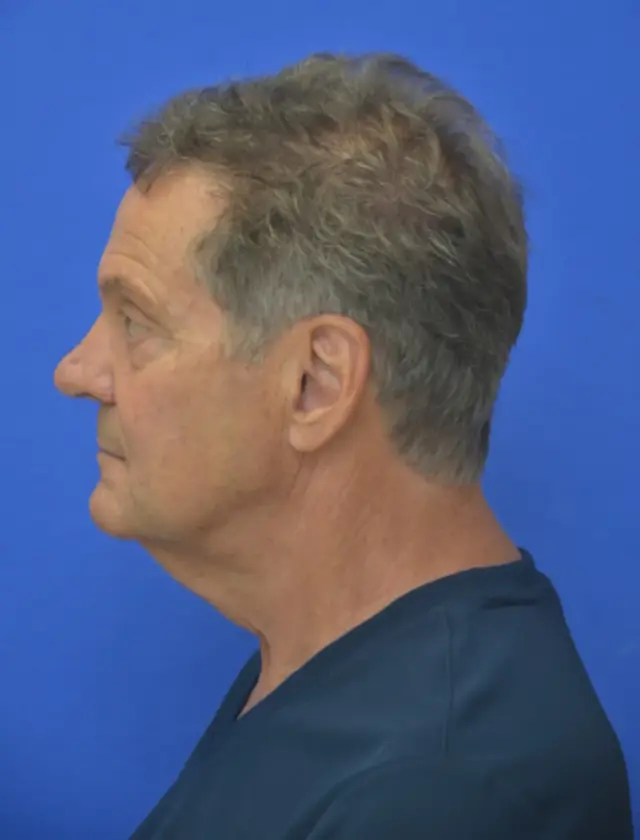 Mini Facelift before at Berman Plastic Surgery & Spa in Boca Raton, FL