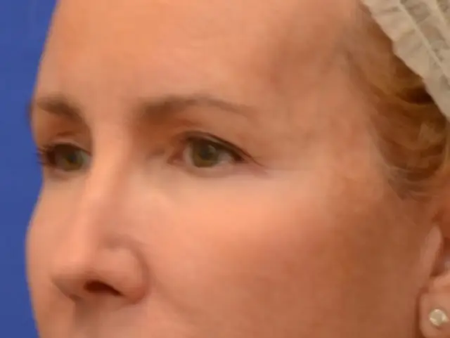 Blepharoplasty before at Berman Plastic Surgery & Spa in Boca Raton, FL