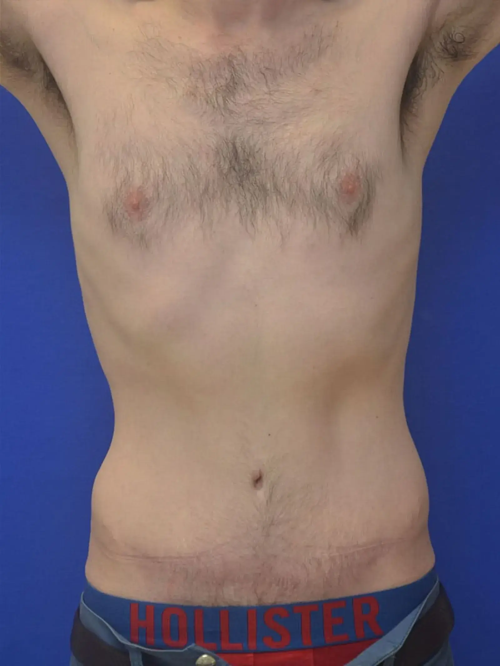 Berman Plastic Surgery & Spa tummy tuck after — Boca Raton, FL