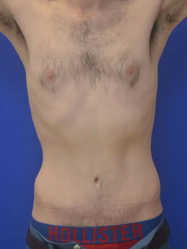 Mini Tummy Tuck after at Berman Plastic Surgery & Spa in Boca Raton, FL