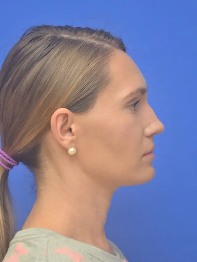 Functional Rhinoplasty before at Berman Plastic Surgery & Spa in Boca Raton, FL