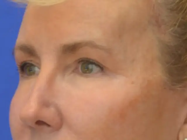 Blepharoplasty after at Berman Plastic Surgery & Spa in Boca Raton, FL