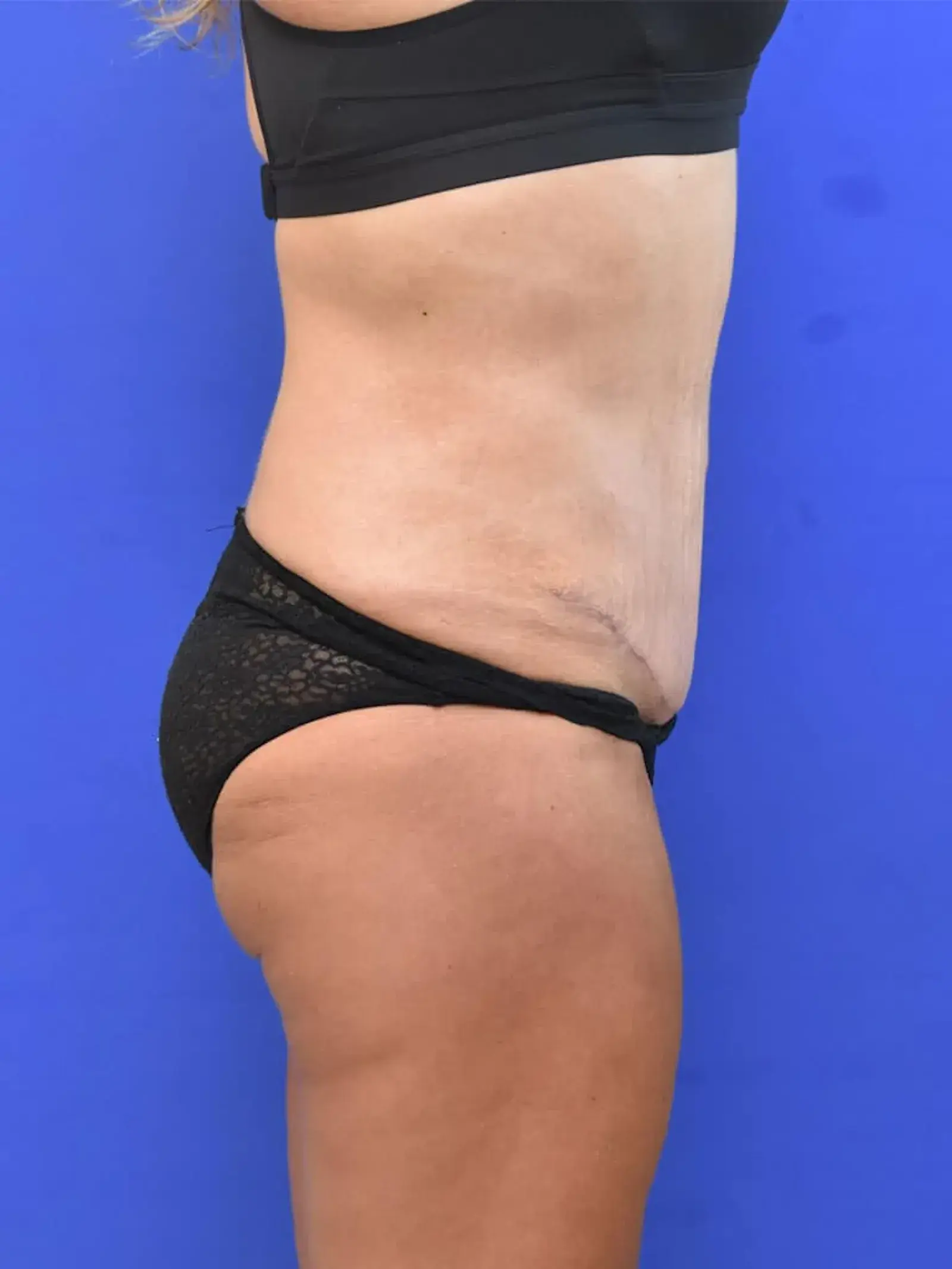 Berman Plastic Surgery & Spa tummy tuck after — Boca Raton, FL