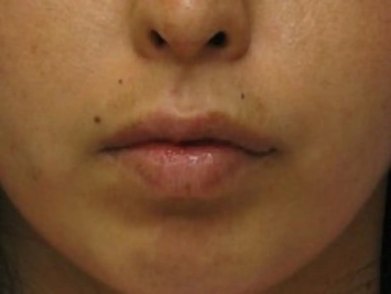 Berman Plastic Surgery & Spa lip filler after — Boca Raton, FL