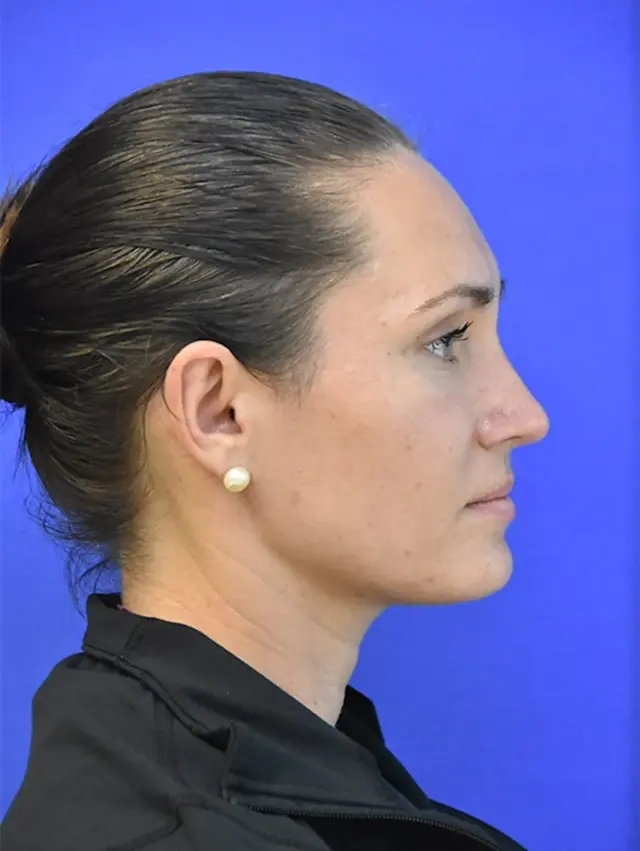 Functional Rhinoplasty after at Berman Plastic Surgery & Spa in Boca Raton, FL