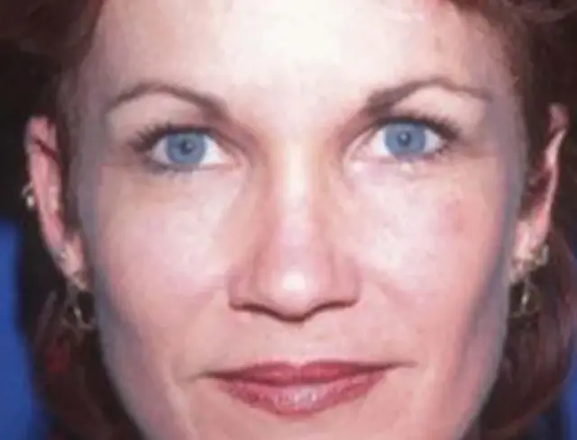 Brow Lift after at Berman Plastic Surgery & Spa in Boca Raton, FL