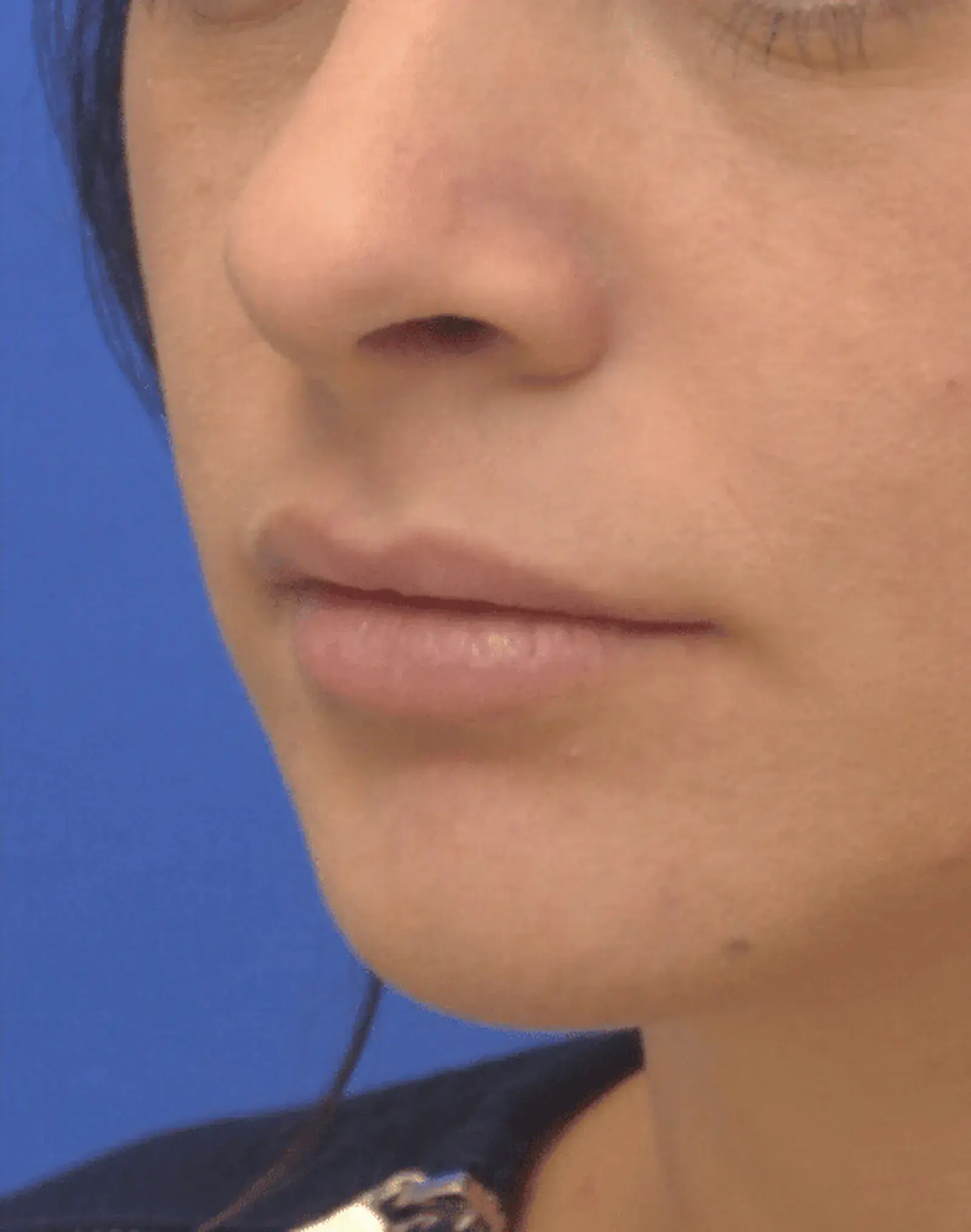 Berman Plastic Surgery & Spa lip filler after — Boca Raton, FL