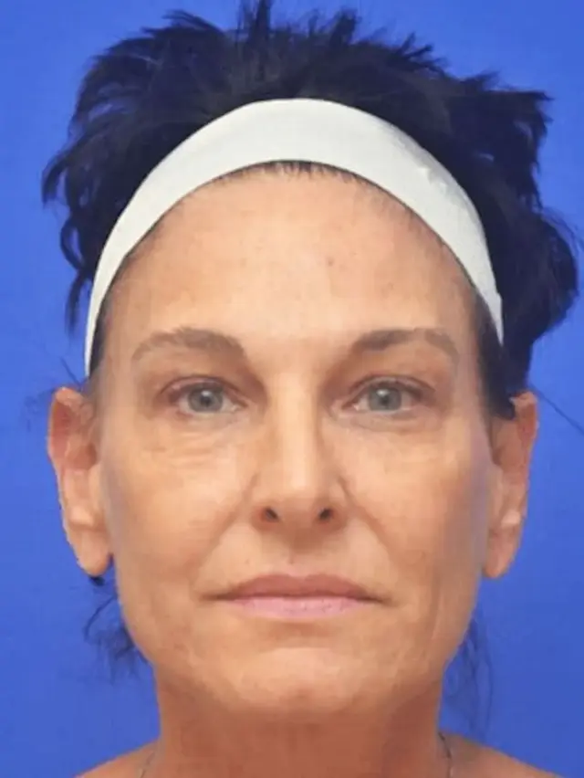 Laser Skin Resurfacing before at Berman Plastic Surgery & Spa in Boca Raton, FL