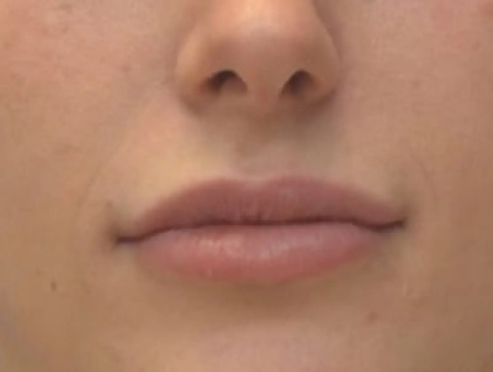 Berman Plastic Surgery & Spa lip filler after — Boca Raton, FL