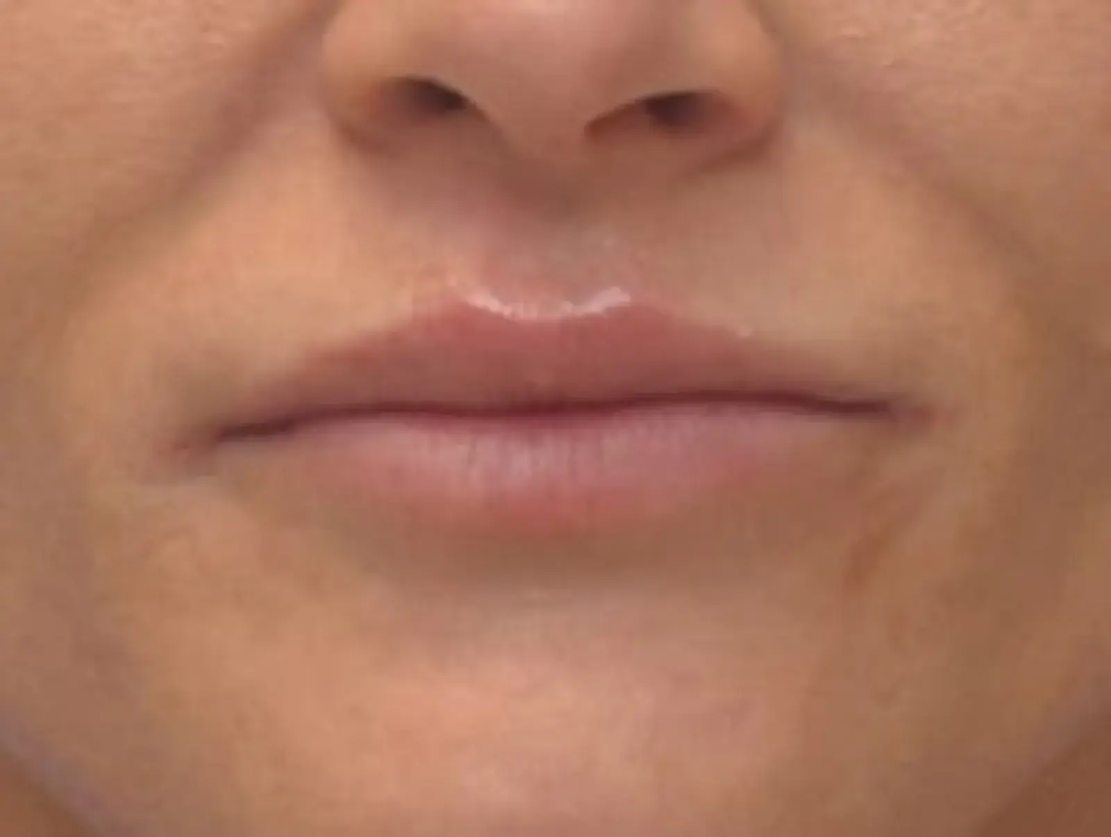 Berman Plastic Surgery & Spa lip filler after — Boca Raton, FL