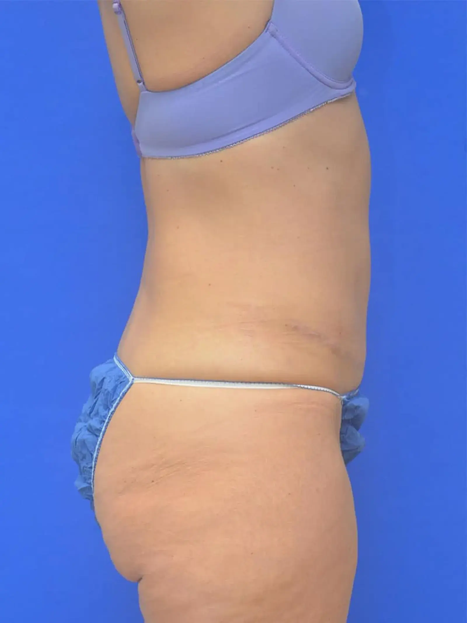 Berman Plastic Surgery & Spa tummy tuck after — Boca Raton, FL