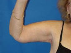Dunedin Plastic Surgery (Jennifer B. Buck, MD) arm lift after — Dunedin, FL