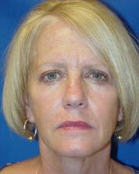 Dunedin Plastic Surgery (Jennifer B. Buck, MD) eyelid lift after — Dunedin, FL