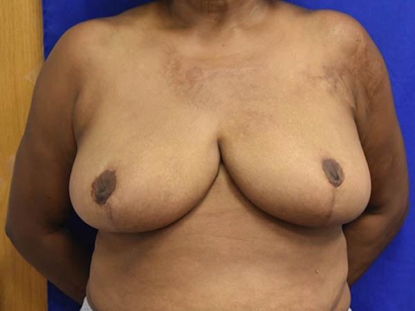 Dunedin Plastic Surgery (Jennifer B. Buck, MD) breast reduction after — Dunedin, FL