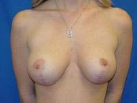 Dunedin Plastic Surgery (Jennifer B. Buck, MD) breast reduction after — Dunedin, FL