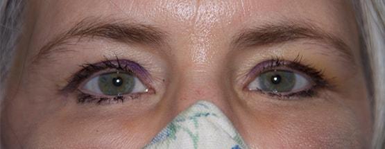 Albert S. Cytryn, MD brow lift after — Bethesda, MD