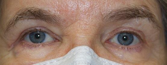 Albert S. Cytryn, MD eyelid lift after — Bethesda, MD