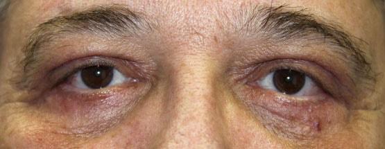 Albert S. Cytryn, MD eyelid lift after — Bethesda, MD