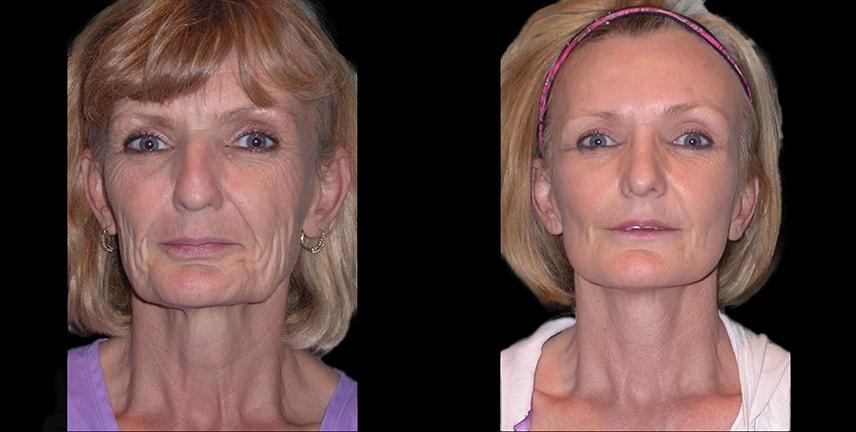 Bellevue Plastic Surgeons facelift result — Bellevue, WA