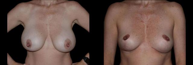 Breast Lift result at Bellevue Plastic Surgeons in Bellevue, WA