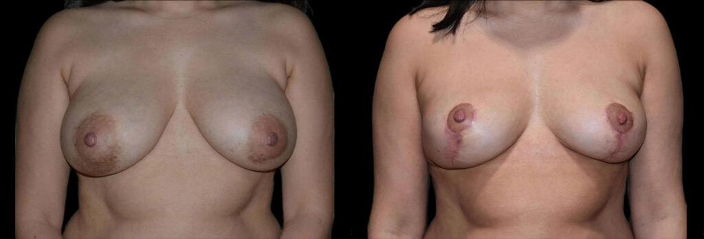 Bellevue Plastic Surgeons breast lift result — Bellevue, WA