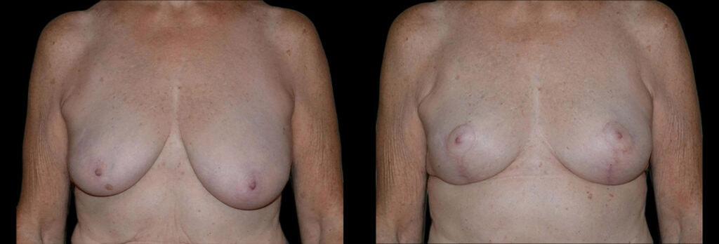 Bellevue Plastic Surgeons breast lift result — Bellevue, WA