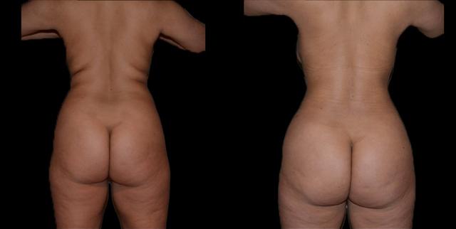 Brazilian Butt Lift result at Bellevue Plastic Surgeons in Bellevue, WA