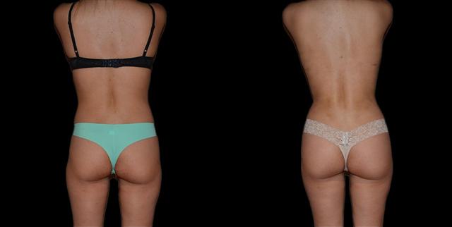 Brazilian Butt Lift result at Bellevue Plastic Surgeons in Bellevue, WA