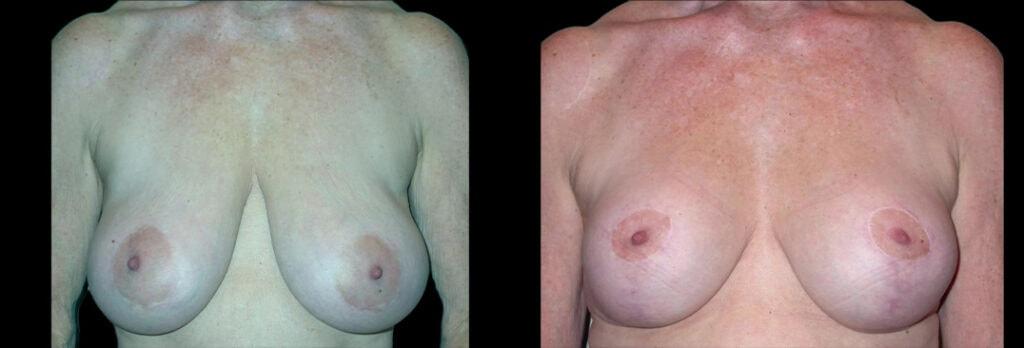 Bellevue Plastic Surgeons breast lift result — Bellevue, WA