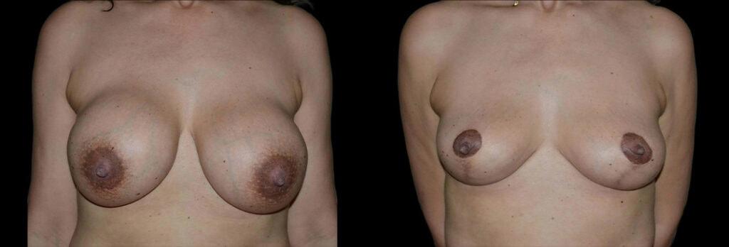Bellevue Plastic Surgeons breast lift result — Bellevue, WA