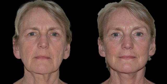 Blepharoplasty result at Bellevue Plastic Surgeons in Bellevue, WA