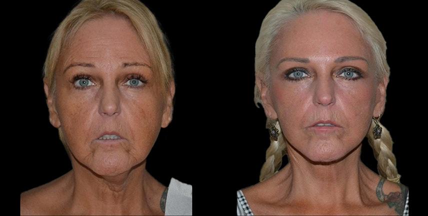 Bellevue Plastic Surgeons facelift result — Bellevue, WA