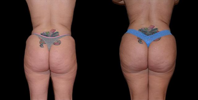 Brazilian Butt Lift result at Bellevue Plastic Surgeons in Bellevue, WA