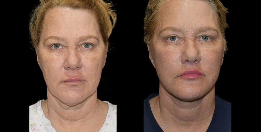 Bellevue Plastic Surgeons facelift result — Bellevue, WA