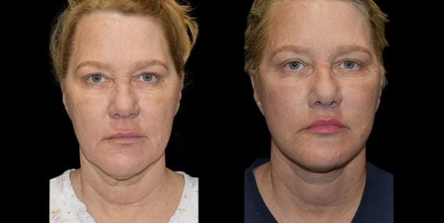 Deep Plane Facelift result at Bellevue Plastic Surgeons in Bellevue, WA