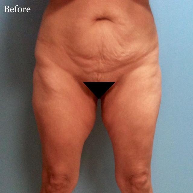 Thigh Lift before at Los Angeles Plastic Surgery in Beverly Hills, CA
