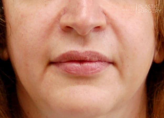 Lip Filler before at Los Angeles Plastic Surgery in Beverly Hills, CA