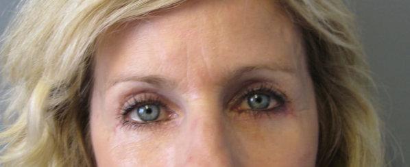 Los Angeles Plastic Surgery result — Beverly Hills, CA