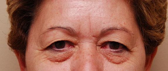 Los Angeles Plastic Surgery result — Beverly Hills, CA